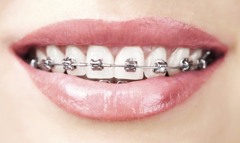 Niềng răng kim loại có chi phí rẻ nhất hiện nay