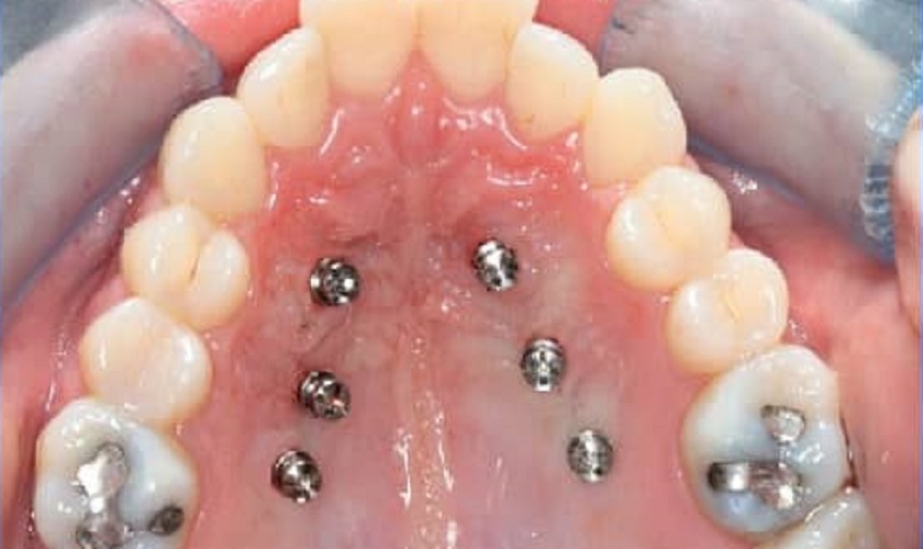 Nong hàm có hỗ trợ bởi Mini-Implant Nong hàm có hỗ trợ bởi Mini-Implant