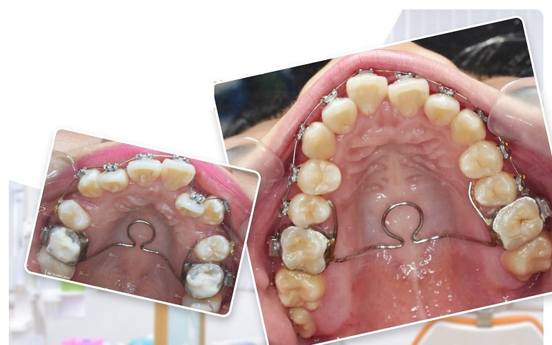 Nong hàm bằng dây cung Nong hàm bằng dây cung