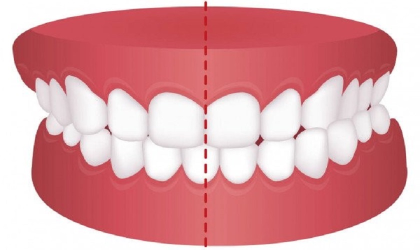 Nong rộng hàm là biện pháp cần thiết để cải thiện khớp cắn chéo Nong rộng hàm là biện pháp cần thiết để cải thiện khớp cắn chéo