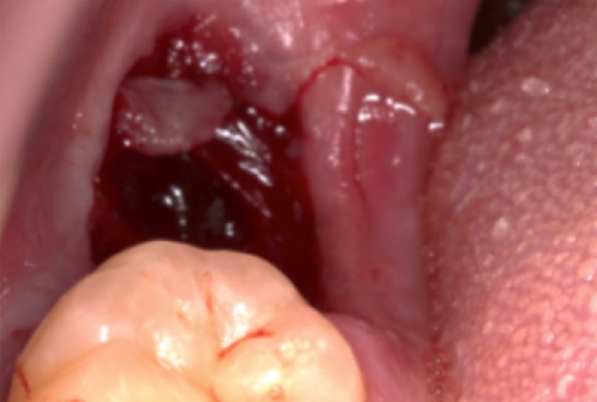 Hình ảnh ổ răng khôn sau khi nhổ Hình ảnh ổ răng khôn sau khi nhổ