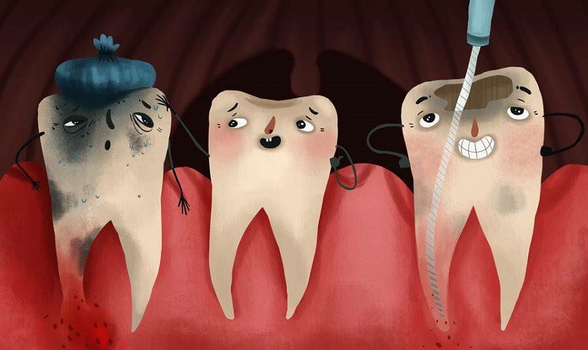 Viêm tủy răng có những dạng nào? Cách điều trị ra sao?