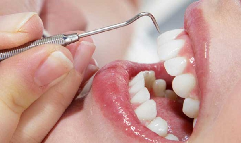 Chi phí cạo vôi răng trên thực tế còn tùy thuộc vào nhiều yếu tố