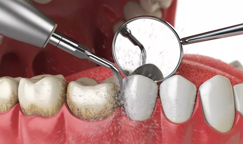 Cạo vôi răng nếu đốm đen trên răng là vôi răng tích tụ lâu ngày