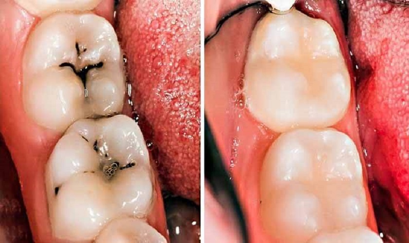 Răng bị đen trên bề mặt: Nguyên nhân và cách xử lý triệt để