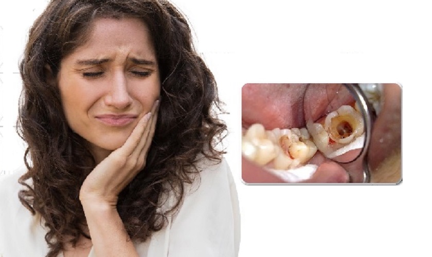 Bệnh lý sâu răng là nguyên nhân hàng đầu khiến răng bị ê buốt khi nhai