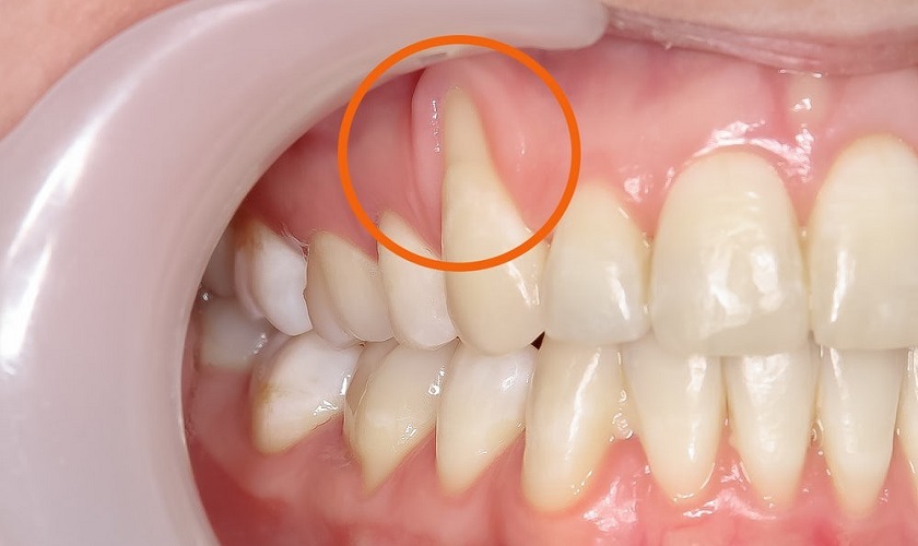 Hiện tượng tụt lợi làm lộ chân răng