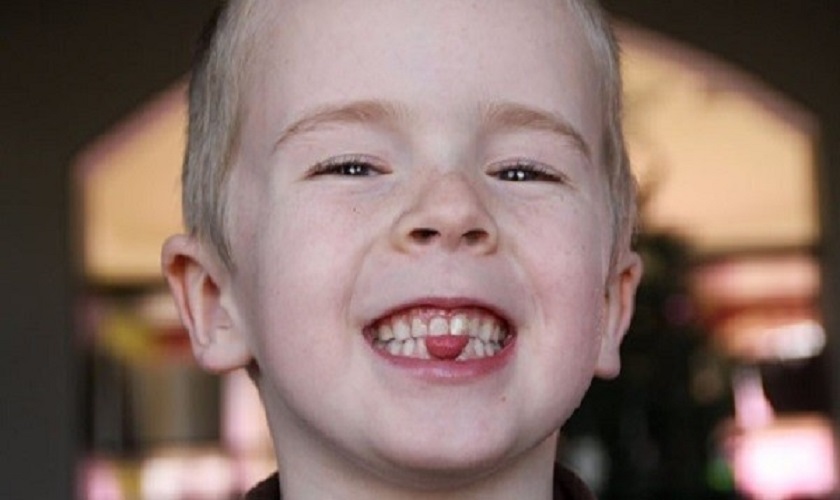 Các thói quen xấu khi còn nhỏ cũng là nguyên nhân khiến răng mọc lòi sĩ