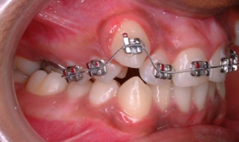 Niềng răng là giải pháp cứu tinh cho những người bị răng mọc lòi sĩ