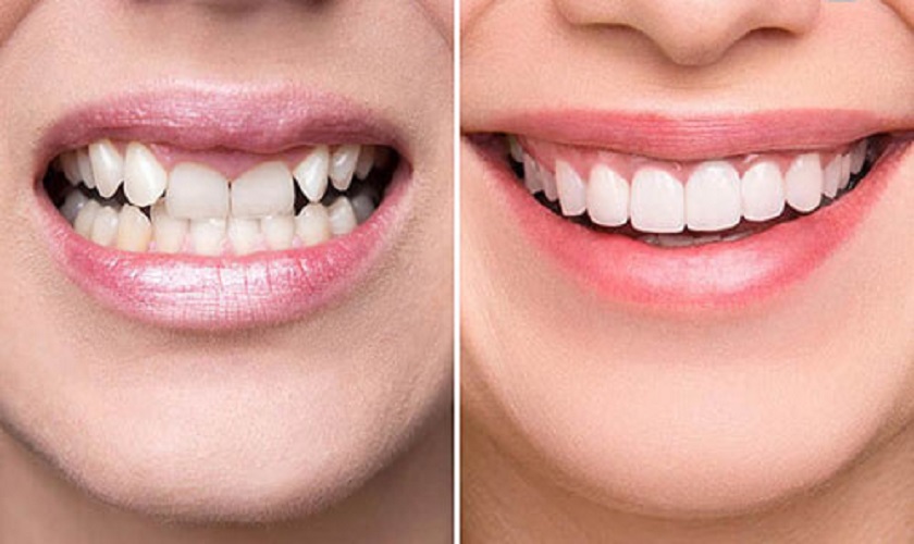 Bọc răng sứ giúp khắc phục răng bị lòi sĩ trong thời gian ngắn