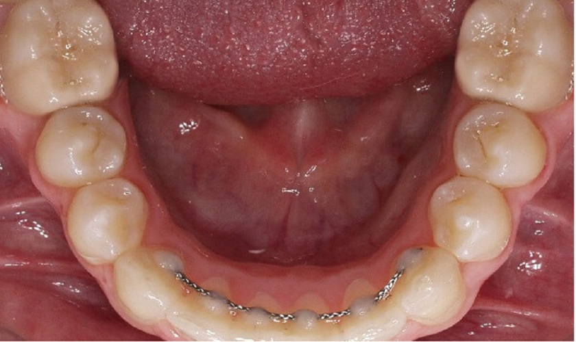 Nẹp cố định răng trong trường hợp lung lay răng do va đập mạnh