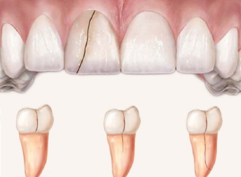 Răng bị nứt không thể tự khôi phục lại ban đầu