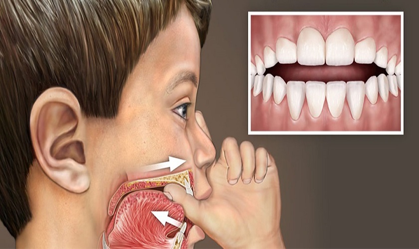 Những thói quen từ khi còn nhỏ có thể khiến răng cửa bị lệch