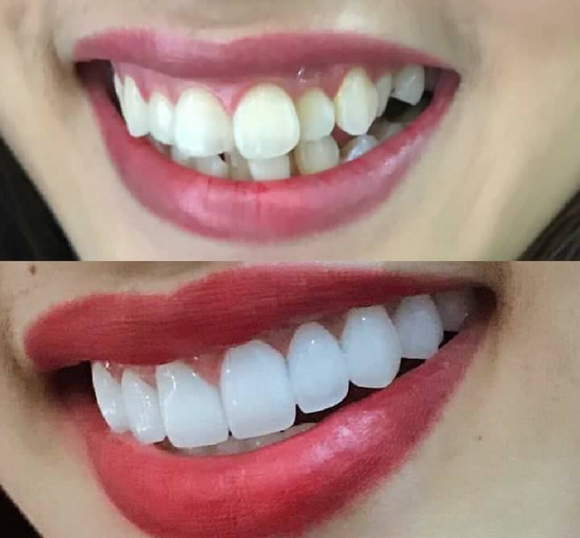 Bọc răng sứ khắc phục hiệu quả tình trạng lệch răng cửa