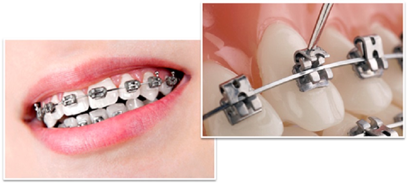 Niềng răng giúp khắc phục triệt để hiện tượng răng cửa bị lệch