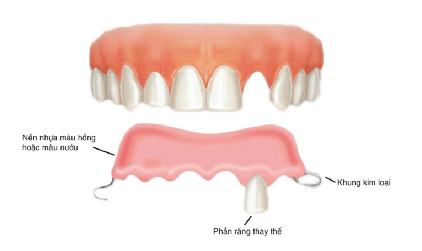 Răng giả tháo lắp 1 chiếc