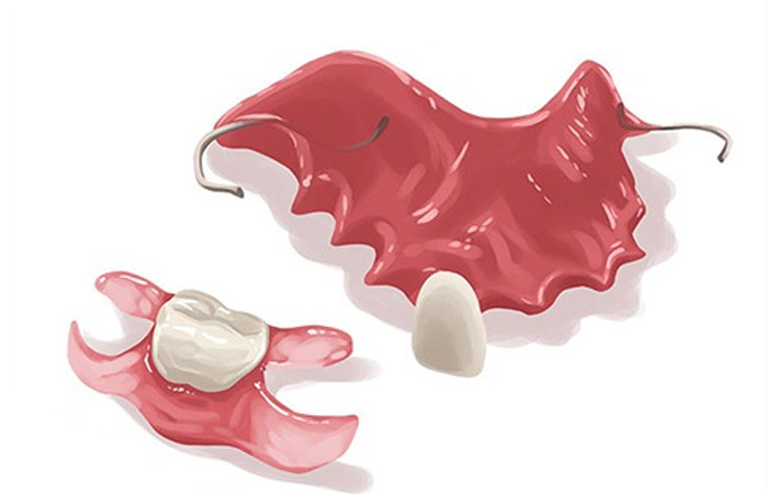 Răng giả tháo lắp 1 chiếc bằng nhựa dẻo