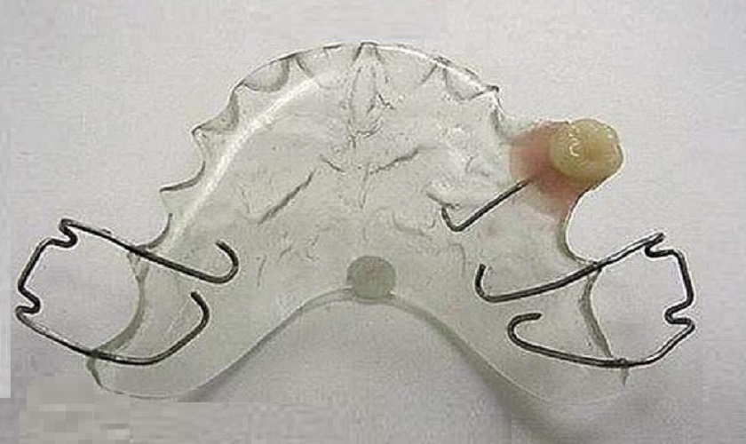 Răng giả tháo lắp khung kim loại