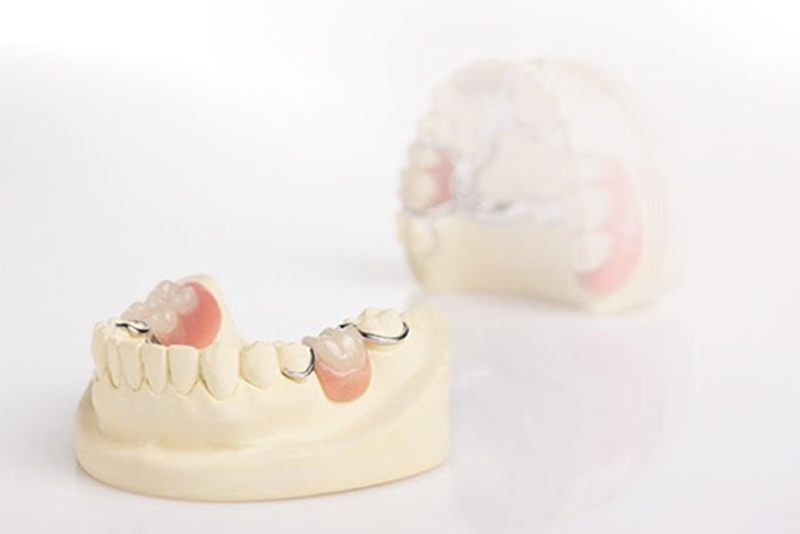 Răng giả tháo lắp 1 chiếc là gì? Có tốt không?