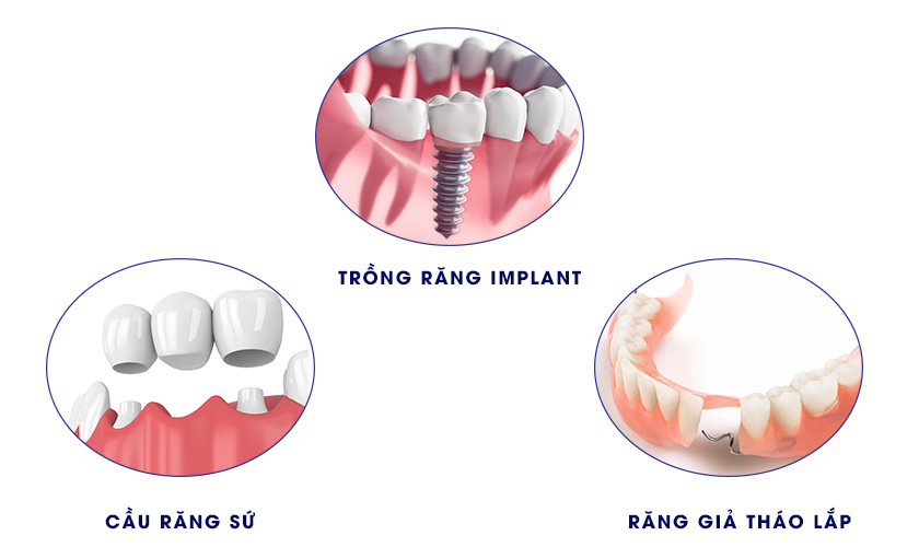 Các phương pháp trồng răng giả hiện nay