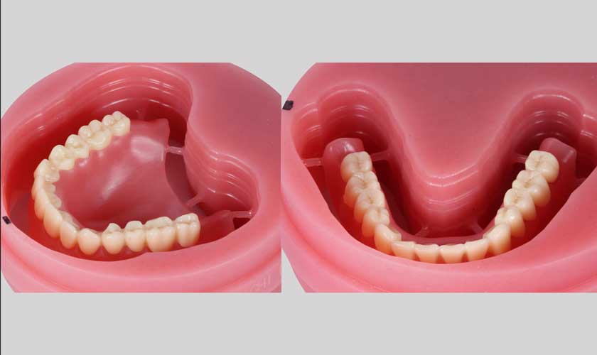 Hàm giả tháo lắp không thể ăn nhai như răng thật