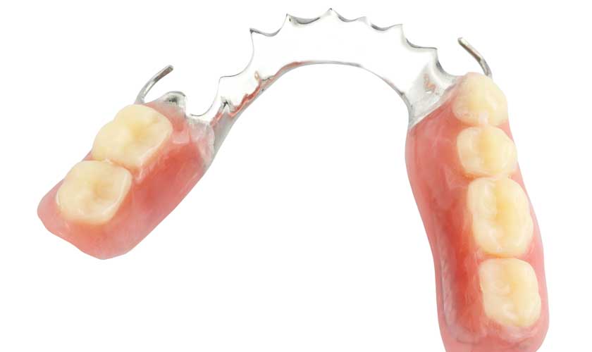 Răng giả tháo lắp điều trị mất răng