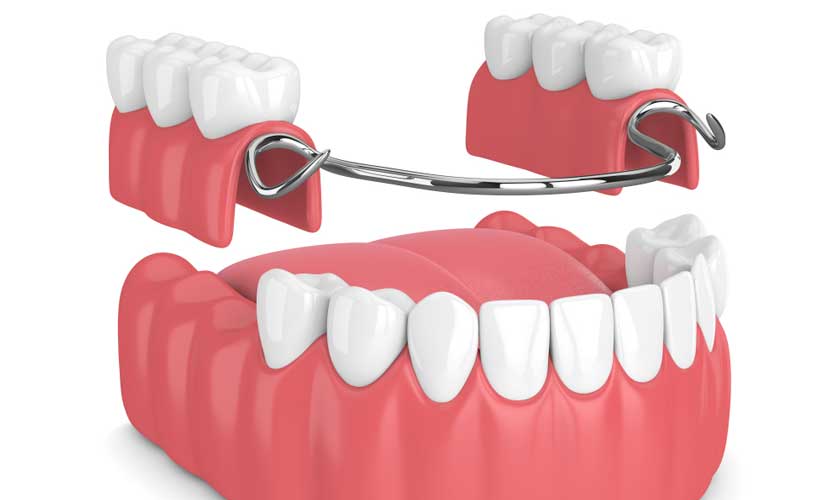 Hàm giả tháo lắp khung kim loại