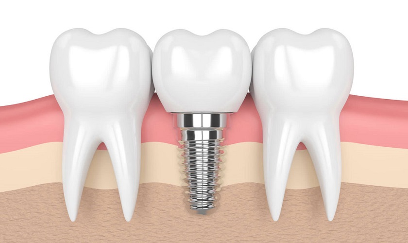 Trồng răng Implant