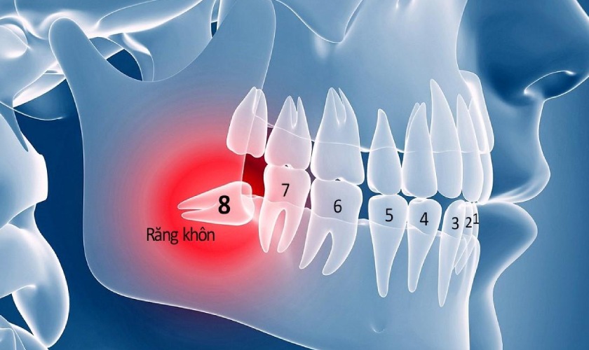 Đau răng khôn do rất nhiều nguyên nhân gây nên