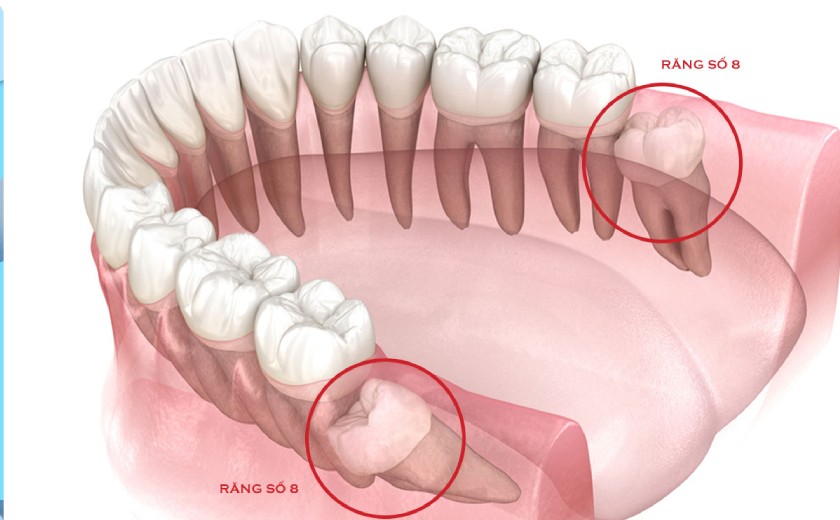 Răng khôn, là những chiếc răng mọc ở vị trí cuối cùng trên cung hàm Răng khôn, là những chiếc răng mọc ở vị trí cuối cùng trên cung hàm