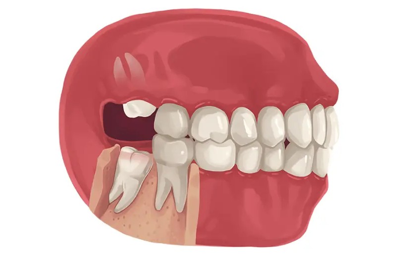 Số lượng chân răng khôn có thể thay đổi tùy vào cơ địa từng người Số lượng chân răng khôn có thể thay đổi tùy vào cơ địa từng người
