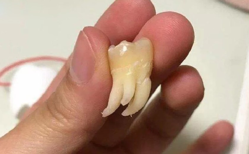 Hình ảnh răng khôn có 3 chân Hình ảnh răng khôn có 3 chân