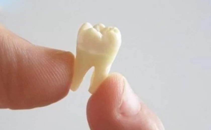 Hình ảnh răng khôn có 2 chân mọc thẳng Hình ảnh răng khôn có 2 chân mọc thẳng