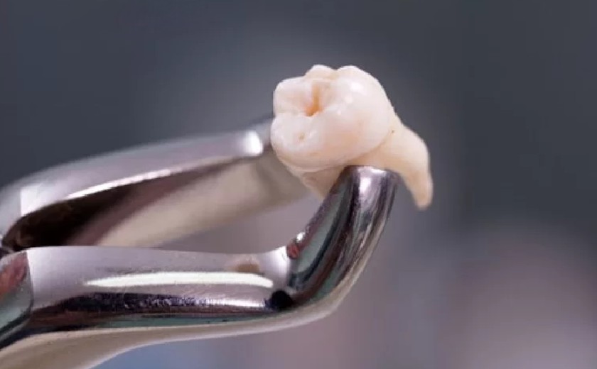 Hình ảnh chân răng khôn móc câu Hình ảnh chân răng khôn móc câu