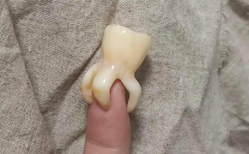 Hình ảnh chân răng khôn bị cong Hình ảnh chân răng khôn bị cong