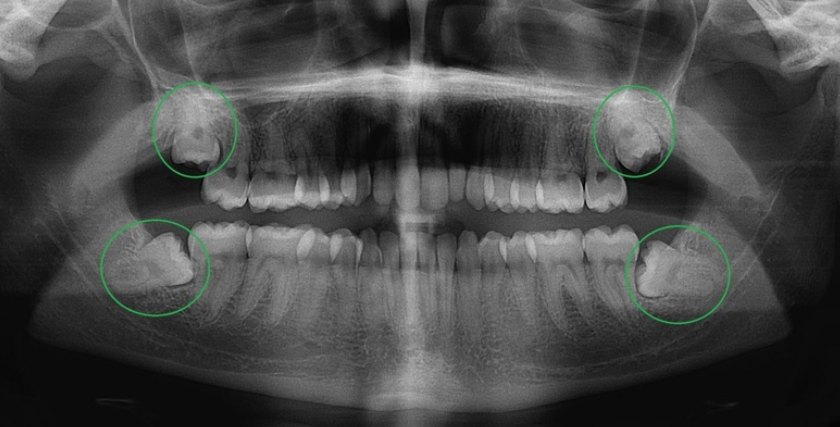 Việc xác định răng khôn có mấy chân nhằm đưa ra phương án điều trị phù hợp nhất Việc xác định răng khôn có mấy chân nhằm đưa ra phương án điều trị phù hợp nhất