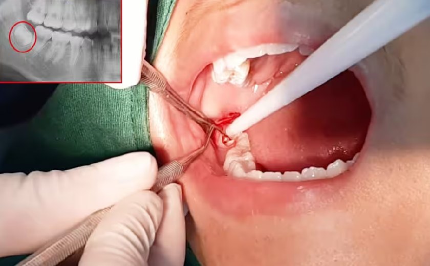 Nhổ răng khôn không gây ảnh hưởng đến hàm răng Nhổ răng khôn không gây ảnh hưởng đến hàm răng