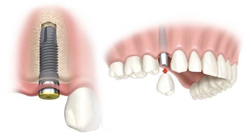 Nếu bị mất răng nanh, trồng răng implant sẽ là lựa chọn tối ưu dành cho bạn
