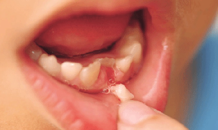 Thay răng sữa không đúng thời điểm khiến các răng mọc chồi, chen chúc với nhau