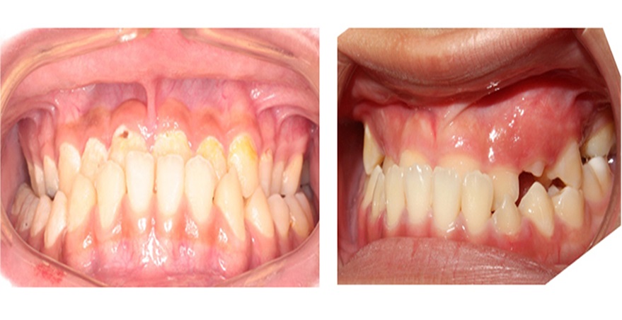 Răng mọc lệch vào trong gây mất thẩm mỹ và tâm lý tự ti