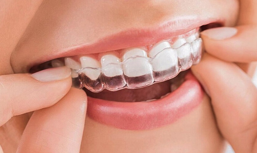 Niềng răng trong suốt đảm bảo thẩm mỹ tối ưu