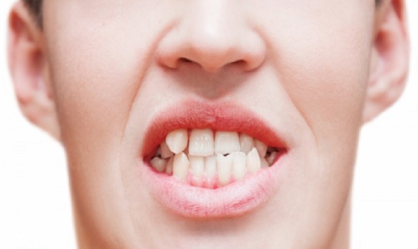 Răng mọc lệch vào trong gây ảnh hưởng thế nào? Làm sao để khắc phục?