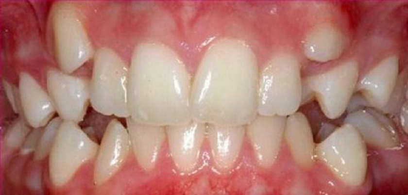 Hiện tượng răng mọc trên lợi