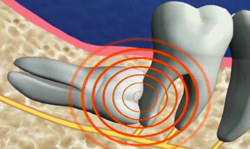 Răng khôn mọc ngược