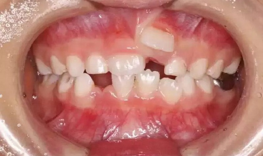 Răng mọc trên lợi ở trẻ em