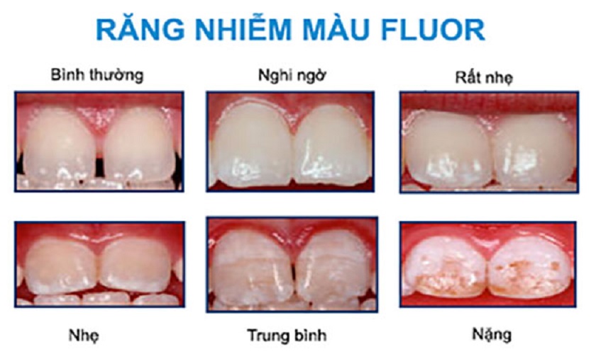 Dấu hiệu nhận biết răng nhiễm flour