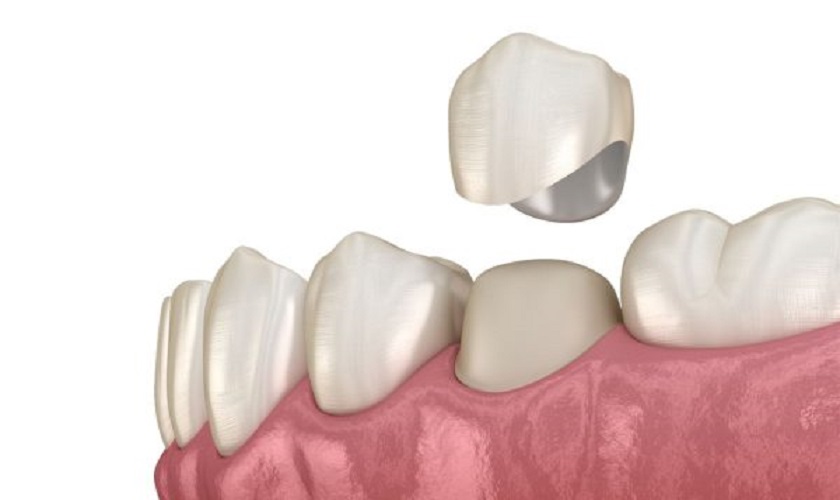 Bọc răng sứ giúp cải thiện hiệu quả tình trạng răng bị nhiễm flour