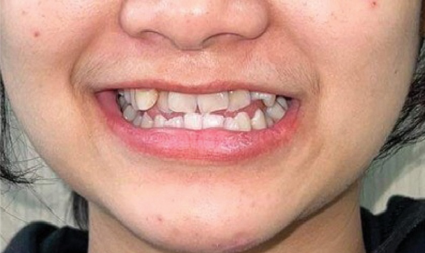 Răng mọc lộn xộn, chen chúc gây mất thẩm mỹ