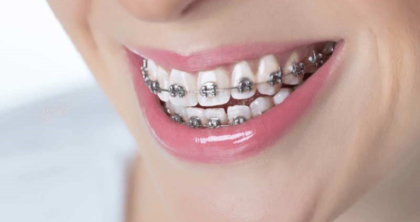 Niềng răng giúp phòng ngừa bệnh lý liên quan đến răng miệng