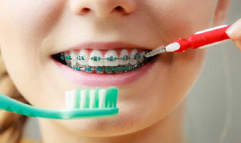 Quá trình niềng răng giúp bạn tạo thói quen vệ sinh răng miệng hợp lý